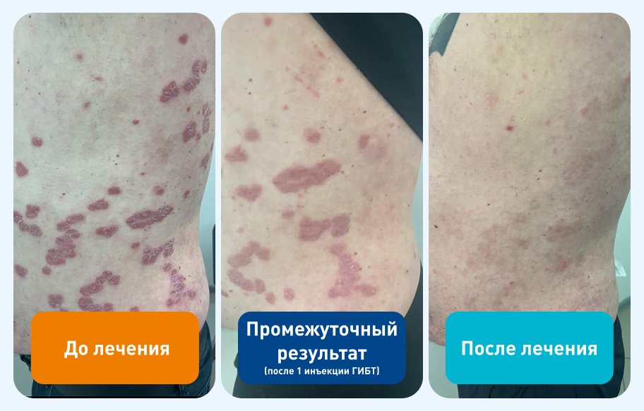 Псориаз. Результат лечения в Медикал Он Груп - Балашиха